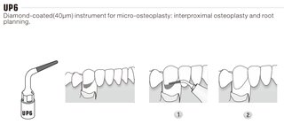 Parodontale-Spitze kompatibel mit Mectron Piezosurgery