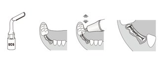 Extraktionsge / Osteotom kompatibel Mectron Piezosurgery