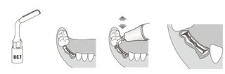 Extraktionsge / Osteotom kompatibel Mectron Piezosurgery